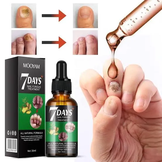Mooyam 7days Nail Fungus Treatment 30ml - Image 1