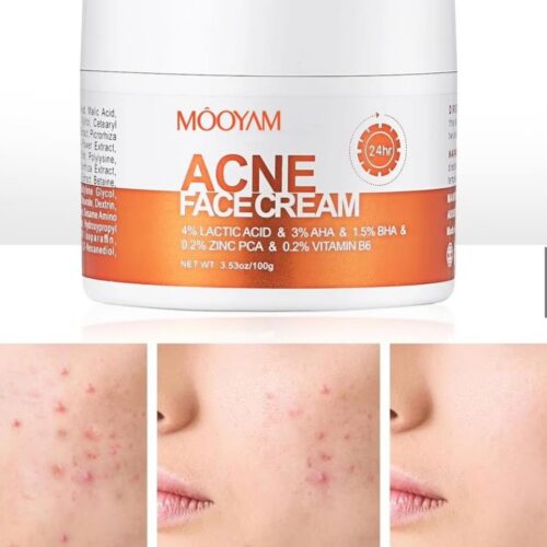 Acne face cream
